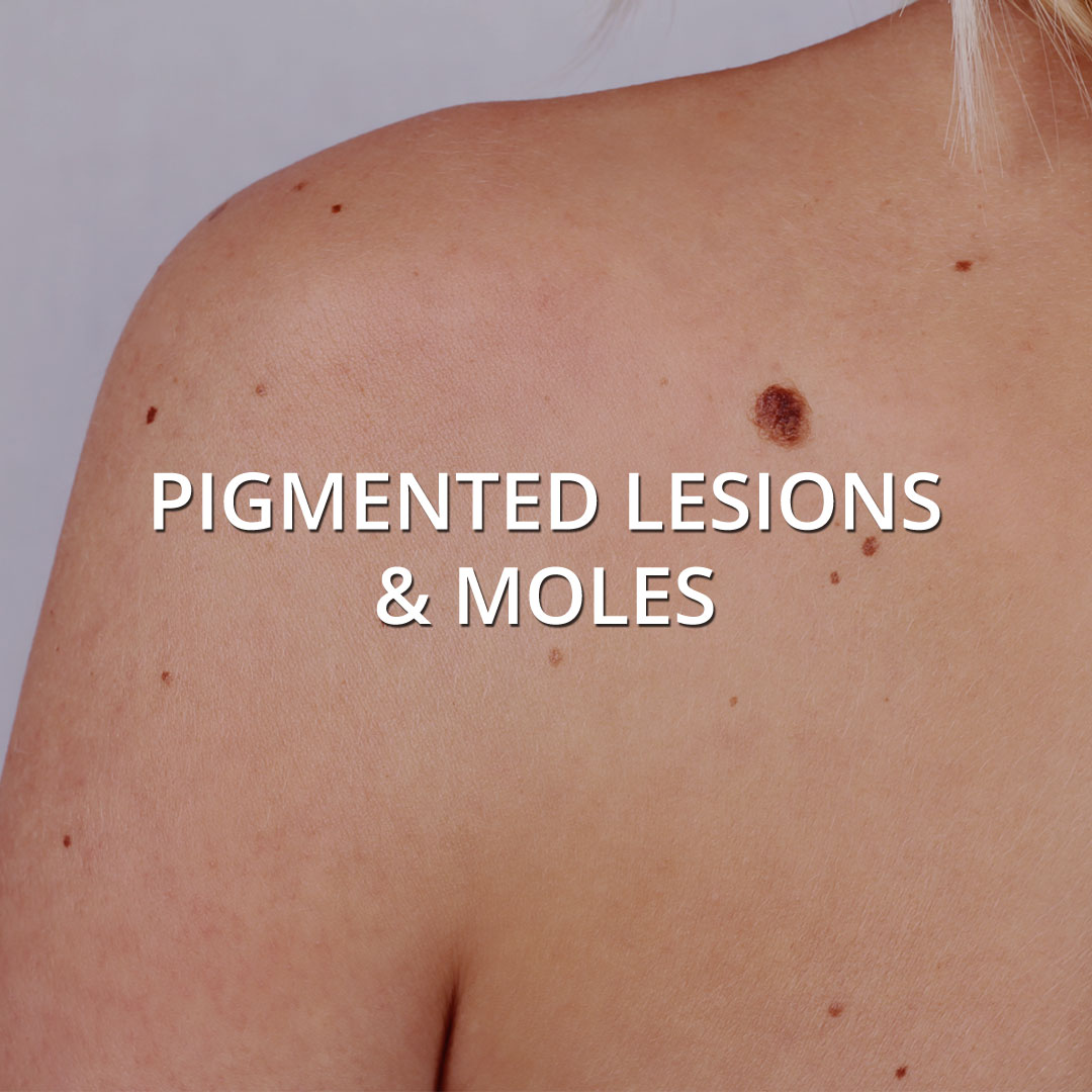 Pigmented Lesions treatment at Vancouver Medi Spa