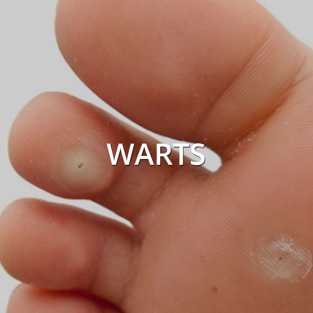Warts treatment at Vancouver Medi Spa