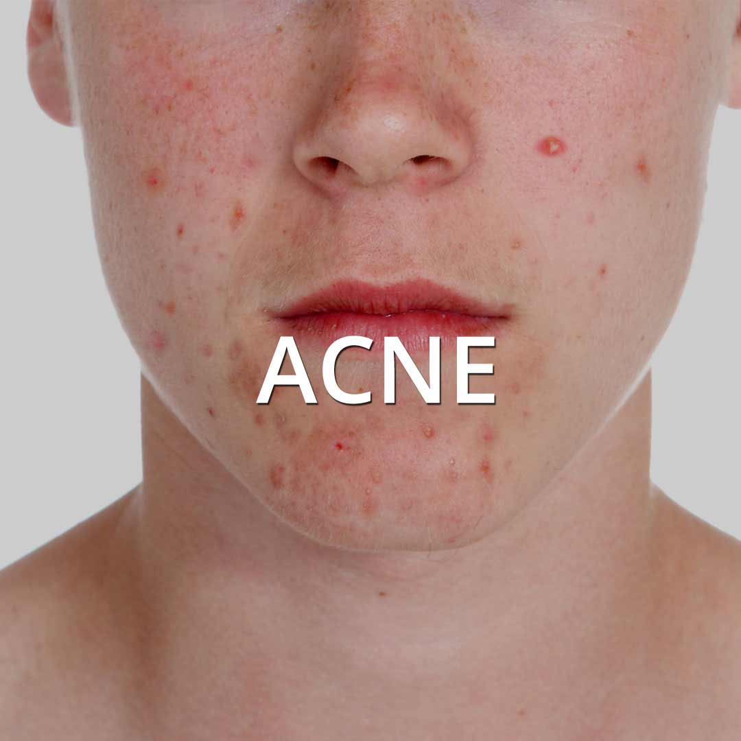 Acne & Acne Scars treatment at Vancouver Medi Spa