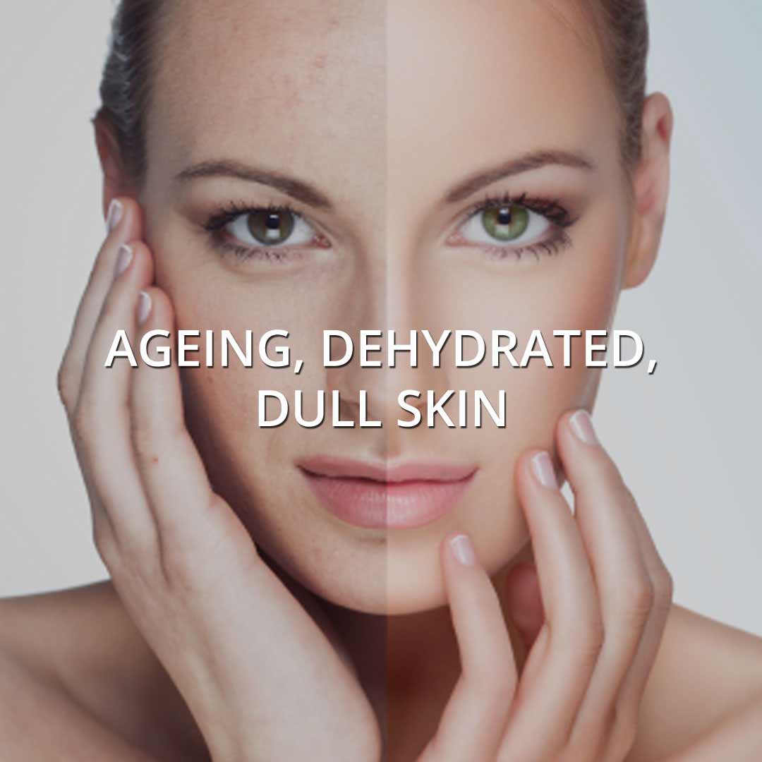Ageing & Dehydrated Skin treatment at Vancouver Medi Spa