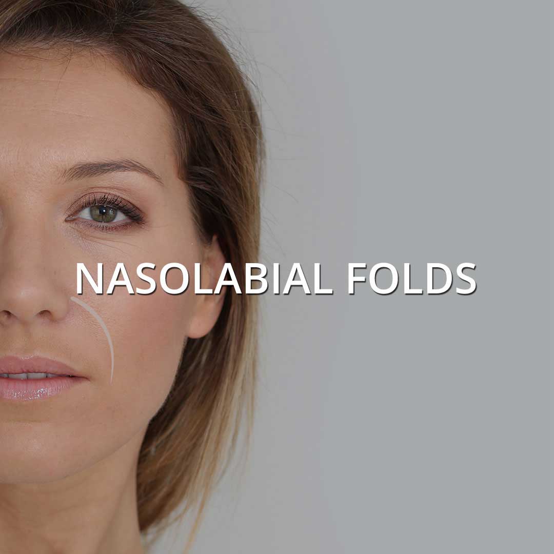 Nasolabial Folds treatment at Vancouver Medi Spa