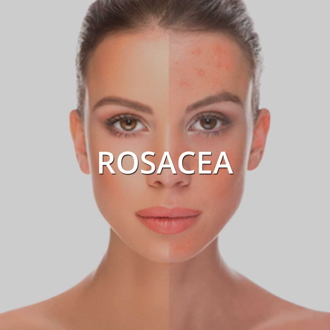 Rosacea treatment at Vancouver Medi Spa