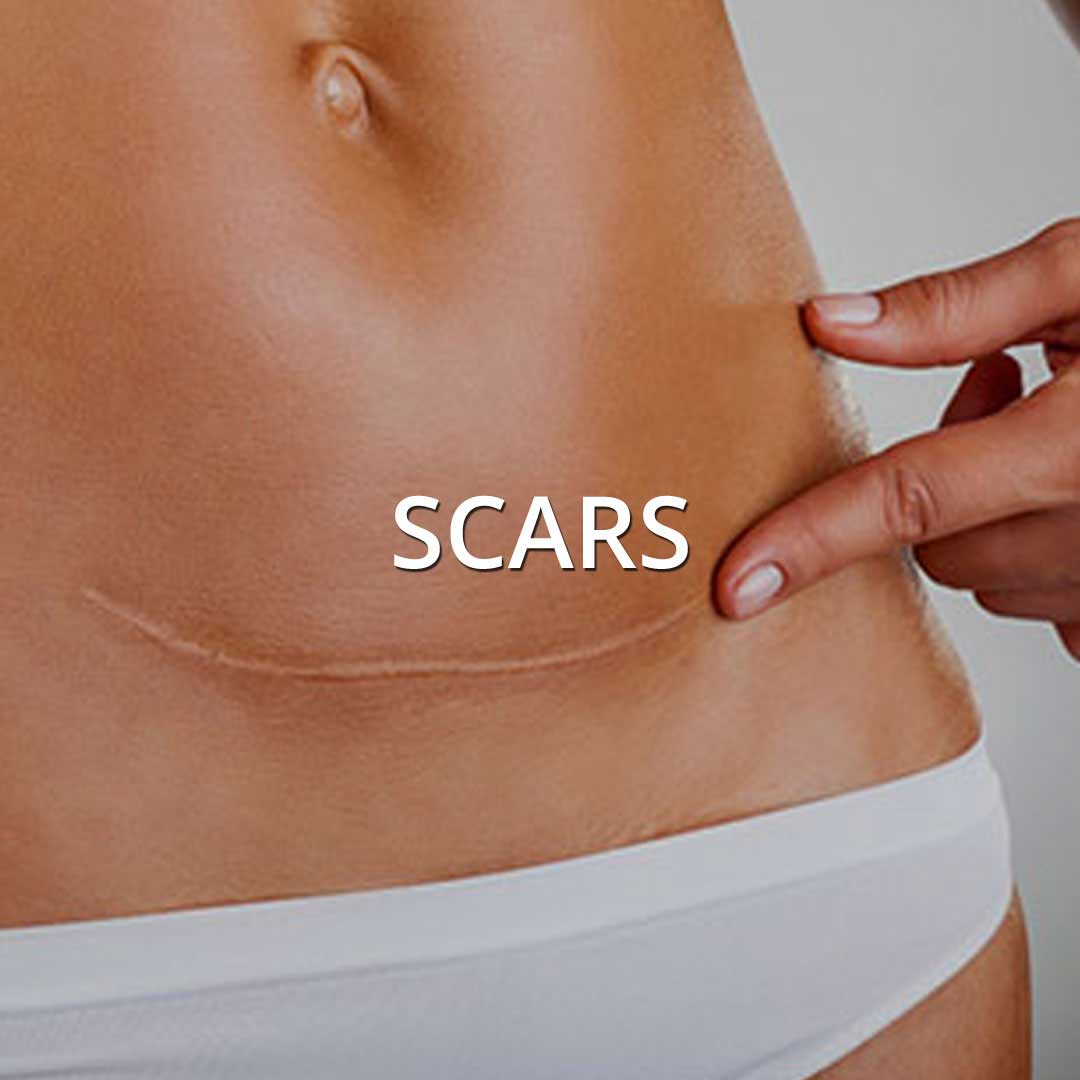 Scars treatment at Vancouver Medi Spa