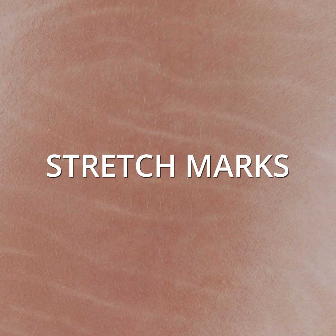 Stretch Marks treatment at Vancouver Medi Spa