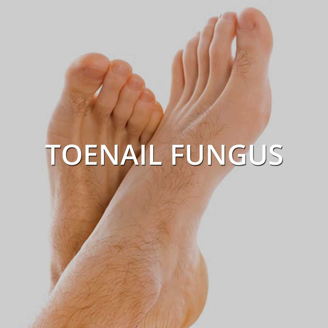 Toenail Fungus treatment at Vancouver Medi Spa