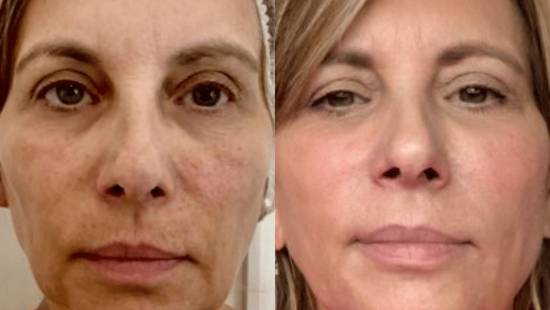 Fotona 4D facelift before and after, Fotona clinical image