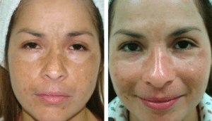 Pigmentation before and after, Fotona clinical image
