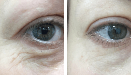 SmoothEye before and after, Fotona clinical image