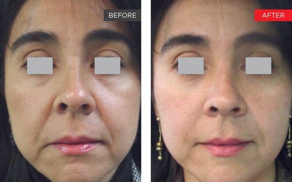 Smile lines before and after, Fotona clinical image