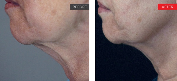 Neck and jawline before and after, Fotona clinical image