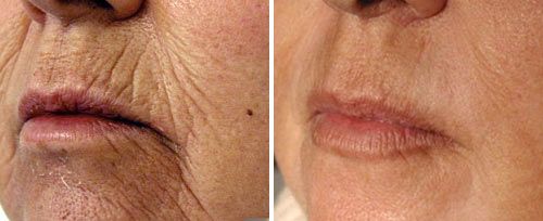 Lip lines resurfacing before and after, Fotona clinical image